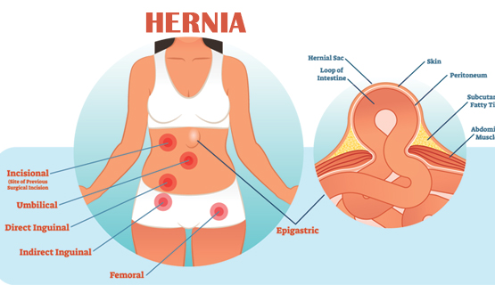 Basic Information About Hernia